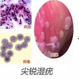 尖锐湿疣,病因、症状及防治策略